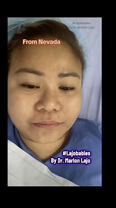 1K views · 99 reactions | 6th week #Rhinoplasty #earcartilage #goretex #drlajo #lajobabies #docmarlonlajo #marlonlajo #lajo #Philippines | Marlon O. Lajo | Facebook
