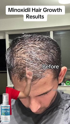 Minoxidil Topical Solution - Hair Growth Serum 💯% Results ✅ World Wide Popular IngredientOrder now https://mamasjan.com/products/bolan-minoxidil-topical-solution-hair-growth-serum | Chiltan Pure Pakistan - Private Limited