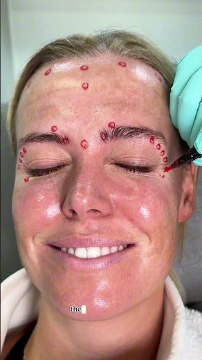 Brow Lift Without Surgery?! 😱💉 Here’s How! #botoxinjections