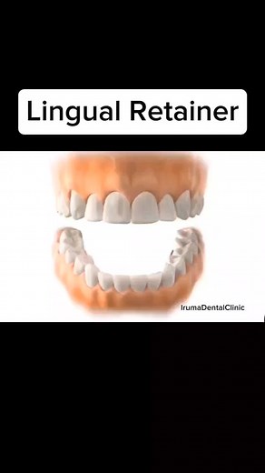 379K views · 562 reactions | All about Lingual Retainer #fbreelsfypシ゚viralfbreelsfypシ゚viral #fbreelsfypシ゚viralシ #fbreels2024 #irumadentalclinic #docanneirumalinto #oralknowledge #dentalknowledgehighhi #oralhealth #follower #everyone #retainers #retainerafterbraces #highlights #dental #dentalcare | Iruma Dental Clinic | Facebook
