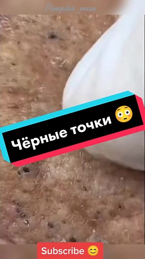 #pimples #acne #черныеточки #сальныепробки #камедон #рекомендации