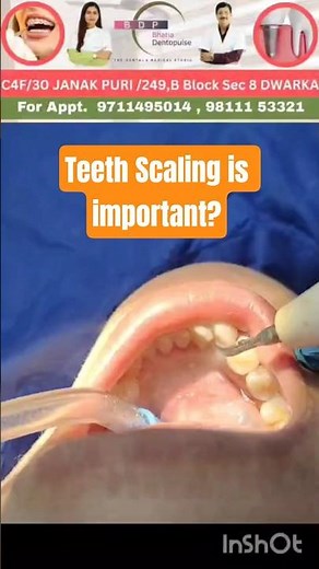Teeth Scaling is important? #scaling #dentist