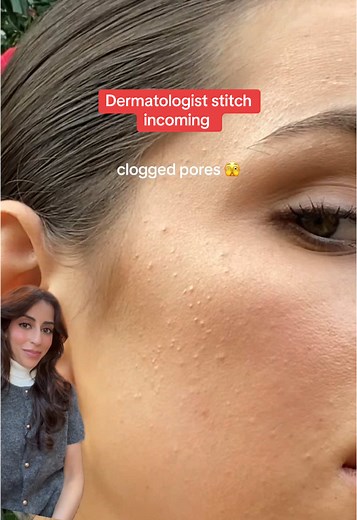 Dermatologist's 3-Step Guide to Treat Under-Skin Bumps