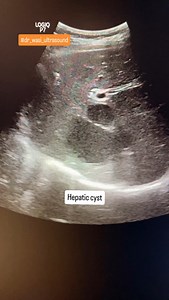 2.3K views · 246 reactions | Hepatic cyst #hepaticcyst #radiologist #neetpg #medicaleducation #radiologie #radiologie | Ultrasound made easy | Facebook