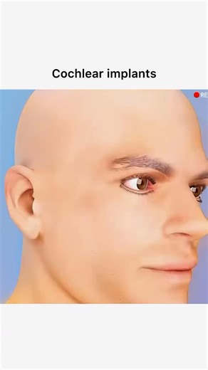 Animations on Instagram: "Follow @surgicalanimation for more!"