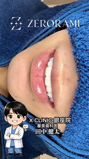 歯を一切削らずにセラミックを貼るだけの治療☺️🦷💎 #審美歯科 #セラミック #ラミネートベニア
