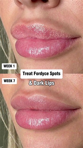 Fordyce Spot Treatment for Lips: Fade Dark Lips in 4–12 Weeks