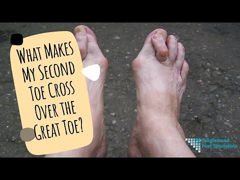 What Makes My Second Toe Cross Over the Great Toe?