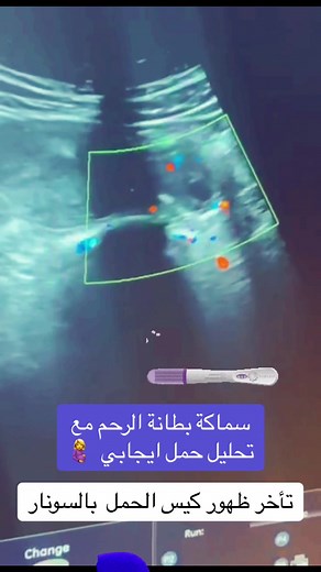 سماكة بطانة الرحم