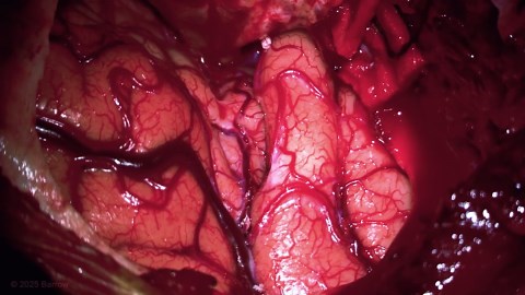 #468:  Mini-Pterional Craniotomy for Clipping of a M2 Middle Cerebral Artery Aneurysm - Aneurysm - Seven Series Collection