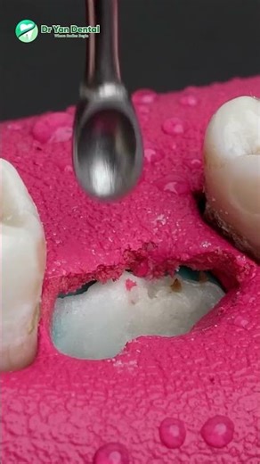 Extreme Deep Cavity Filling – Saving the Tooth Just in Time #dryandental #teethdecay #orthodontist
