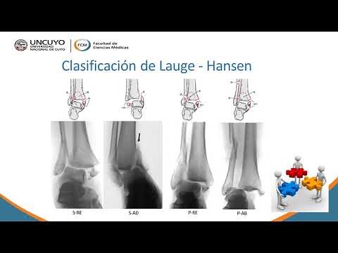 Fracturas de tobillo