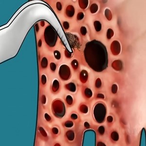 13K views · 139 reactions | Infected foot and maggot removal best satisfying animation | Robin's Garden | Facebook