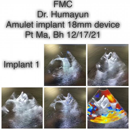 Awais K. Humayun, MD, Pioneering Amulet Use in the US