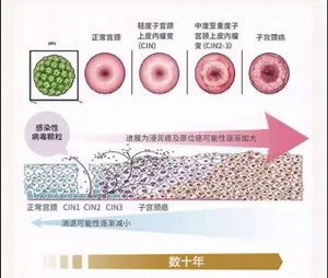 正常宫颈怎么变成宫颈癌 南京华肤医院
