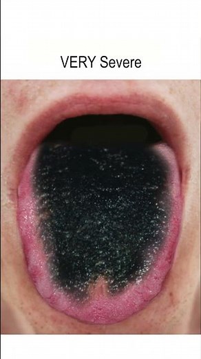 Black Hairy Tongue Progression