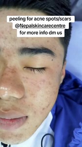 Now ready to say goodbye to your acne problems with the help of Nepal Skin Care Centre locationSinamangal Pipal bot Kathmandu you can also search on your Google map for more info you can contactTel:-1-4589035,4597075,4597074#NepalSkinCareCentre #dermatologist #skintreatment #acnespot #scar #peeling #flawlessskin #acnetreatment #healthyskin #aesthetic #fyp #foryoupageofficiall #everyone | Nepal Skin Care Centre | Facebook