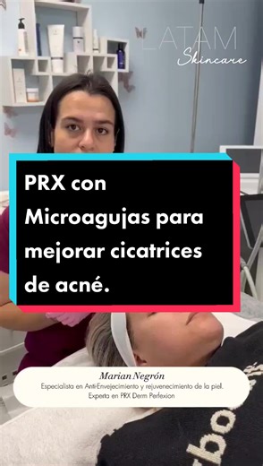 DESDE ITALIA- Tratamiento para mejorar las cicatrices causadas por Acné. Descubre cómo tus pacientes pueden obtener resultados extraordinarios con el tratamiento más innovador que la medicina estética ofrece. PRX Derm Perfexion es un biorevitalizador y regenerador de colageno y elastina. Su fórmula patentada contiene TCA33%, H2O2 y Ácido Kójico lo cual permite obtener resultados inmediatos, sin dolor, sin descamación y sin tiempo de inactividad. Este producto es de grado médico y debe ser aplica