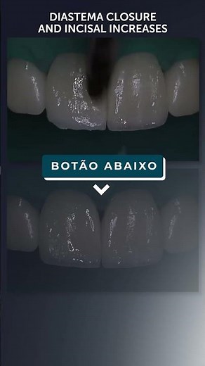 Fechamento de Diastema e Aumentos Incisais