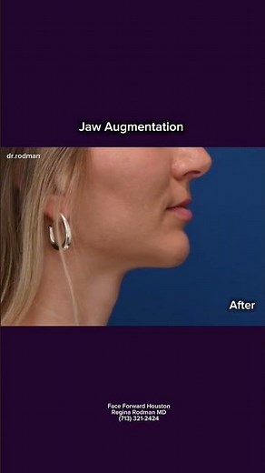JAW AUGMENTATION| CUSTOM JAW IMPLANTS| PLASTIC SURGERY
