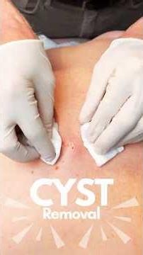 🩺 What Is a Cyst? Causes, Removal & Recovery Explained