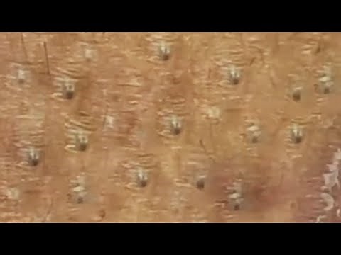 Extraction profonde des points noirs Acné kystique et popping #34