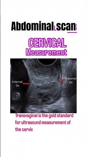 cervical measurement|internal os|external os
