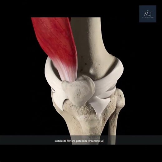 Patellar Dislocation