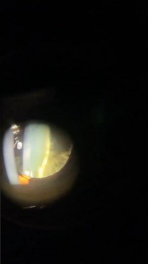 Cortical cataract in Slit lamp examination.