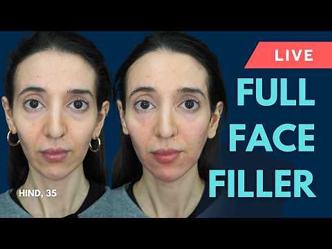 LIVE Multi-Area Filler Treatment 💎 Temple Filler, Tear Troughs, Cheek Filler & Jawline Contouring