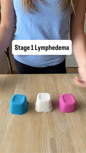 Stages of Lymphedema Explained by a Certified Lymphedema Therapist