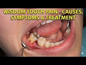 WISDOM TOOTH PAIN Causes Symptoms And Treatment