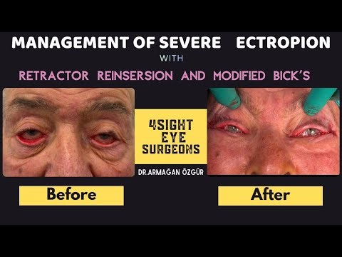 Management of Severe Ectropion with Retractor Reinsertion and Modified Bick's Procedure