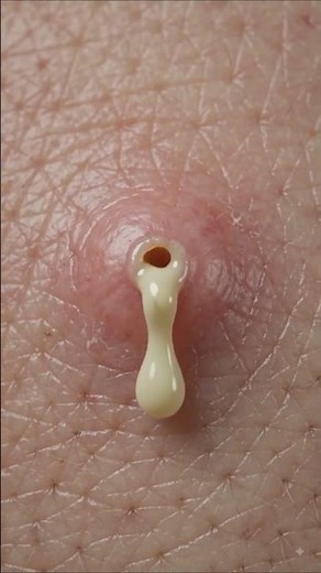 What Happens Inside a Boil? | The Science Behind Skin Infections ✨