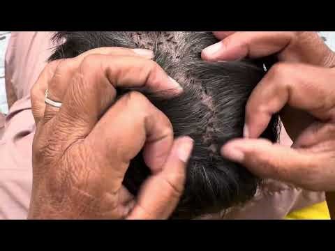 #liceremoval 🔥Most Satisfying Lice Removal ASMR 😱| Wife Deep Cleans hair|Extreme Nits Removal EP 188