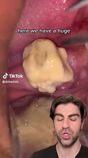 Huge Calculus Buildup on Tooth | Loose Tooth | Dental Cleaning
