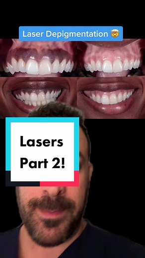 #greenscreen Dark spots on your gums? No problem. There’s a laser for that #laserdentist #laserdentistry #gumbleaching #depigmentation #dentist #gums
