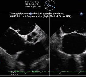 Direct electrosurgical traversal with radiofrequency to prevent obstruction in left ventricular outflow tract (DETROIT) procedure simplifies anterior mitral valve leaflet modification to prevent left ventricular outflow tract obstruction after transcatheter mitral valve replacement. Learn more in #JACCINT: https://bit.ly/3BHcLv6 | JACC Journals