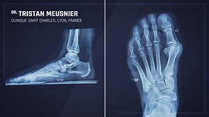 Video chirurgie Pecaplasty