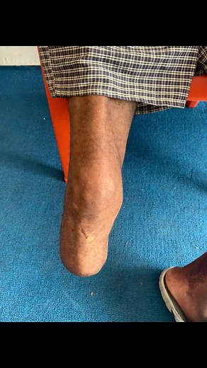 #prosthetics #prosthesis #highrisecare #nigerianprosthesis #amputee #lowerlimbs #rehabilitation #modularprosthesis #silicone