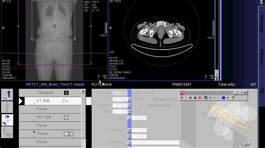 西门子biograph PET CT 图像采集