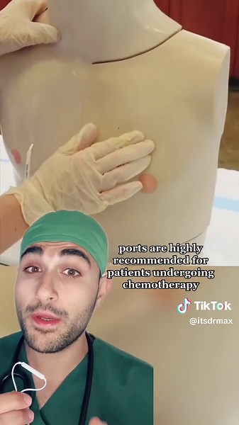 It's fascinating to note that the duration of port usage can vary. Some patients may require ports for a few months, while others might rely on them for several years, depending on their individual treatment plans. #medicine #medical #medtok #vascular #ports #chemotherapy