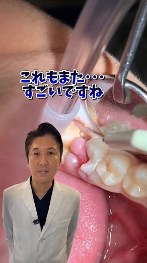 歯茎の痛みと矯正治療の影響
