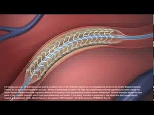 Simulacion Stent Coronario Biorreabsorbible Absorb de Abbott Vascular