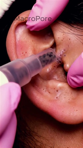 ONE VACUUM — SO MANY COMEDONES 👂 #asmrshorts