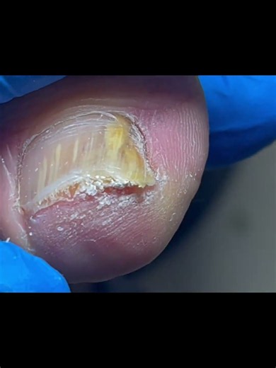 A large patch of onychomycosis was successfully removed. #nails #pedicure