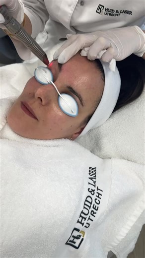 Foxy Eye ooglift behandeling👀🙌🏼 Stel een ooglidcorrectie uit met deze behandeling! Het lift je wenkbrauwen en verstrakt je huid rondom je ogen. #foxyeyes #fotona #eyelift | Huid en Laser Utrecht