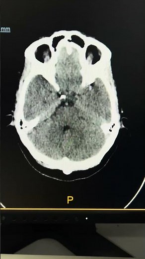 Basal Ganglia Calcification in CT Brain 🧠 #radiology