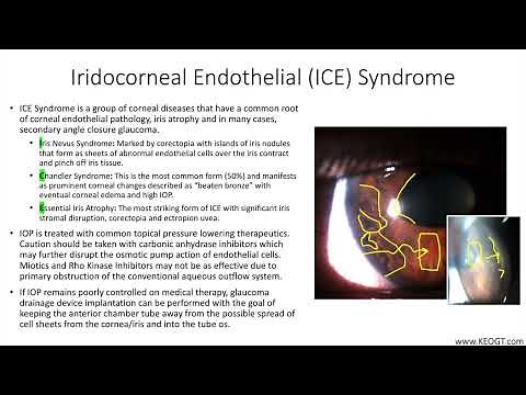 Lecture: Iridocorneal Endothelial (ICE) Syndrome (1 Slide in 5 Minutes)