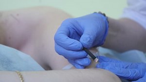 Acupuncture Needles On Female Body Acupuncture Stock Footage Video (100% Royalty-free) 1009482626 | Shutterstock